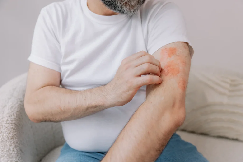 Une personne qui souffre d'Inflammation de la peau