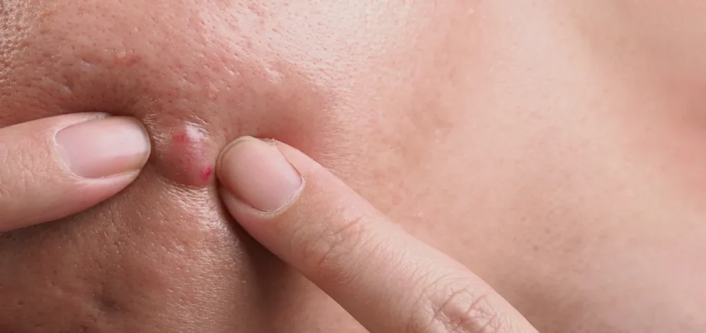 Une personne qui perce un bouton